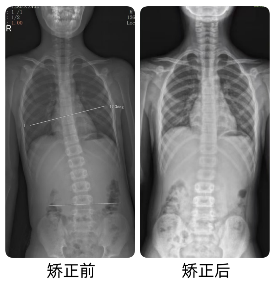 10岁男孩脊柱像一棵"长歪的小树"!这些信号家长一定要警惕