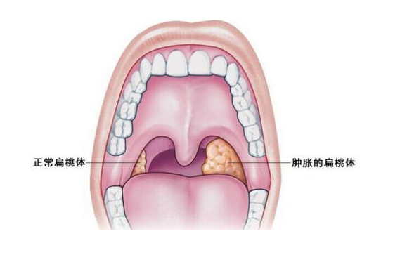 扁桃体发炎最快治疗方法（快速治疗扁桃体发炎）