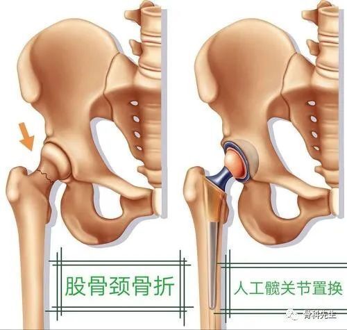 股骨颈骨折位置图图片