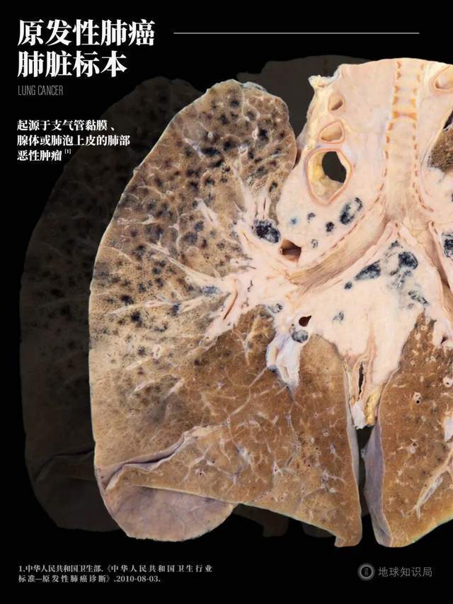 我国每年新发肺癌患者106万例,高居我国恶性肿瘤发病率第一名,占全球