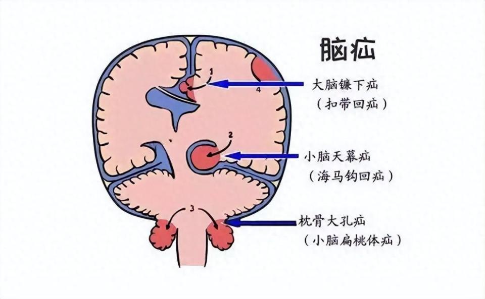 脑疝图片及图解图片