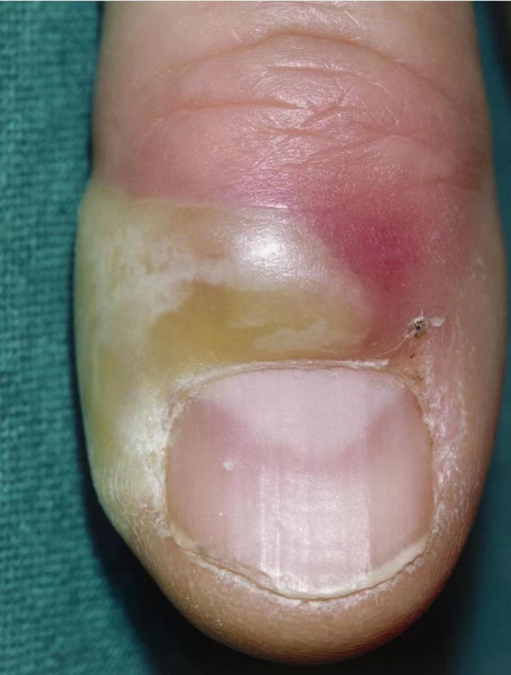 "钟剑波听后哭笑不得,最终老吴被确诊为甲沟炎导致的手指化脓性感染.