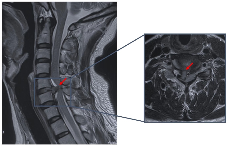 女子右侧手脚失灵以为中风原来是颈椎间盘突出惹的祸