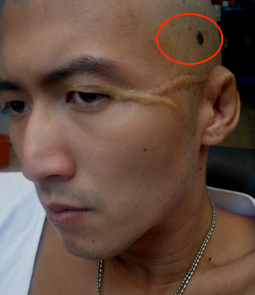 汪峰徒弟去世,患黑色素瘤年仅37岁,网友恐慌:我身上也有痣-腾讯新闻