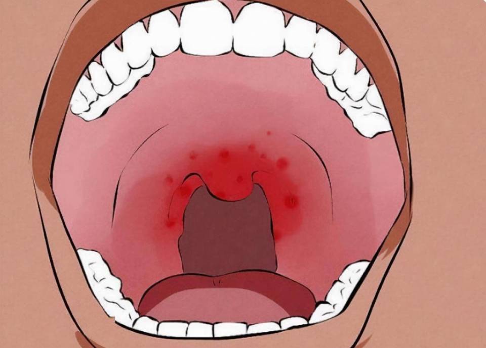 口腔溃疡持续疼痛不愈?小心口腔癌!这些早期预警信号要注意!_腾讯新闻