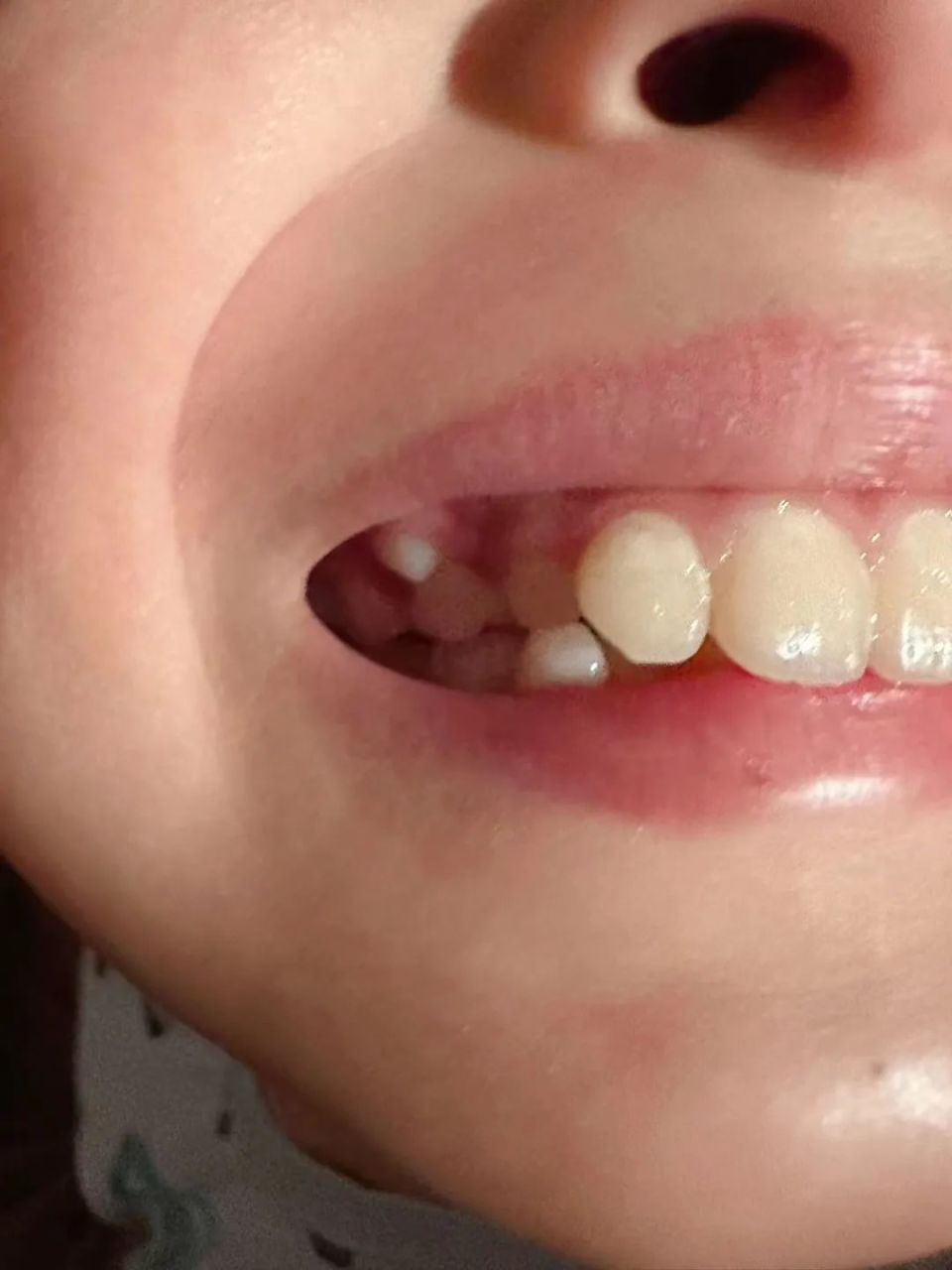 双排牙的意思就是,孩子的乳牙还没掉,新的恒牙就长出来了,造成乳牙和