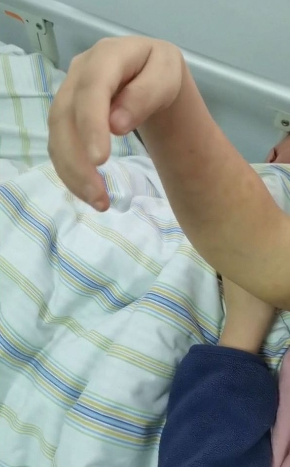 胳膊意外被床板压住4小时,女子桡神经"罢工"数月抬不起手腕_腾讯新闻