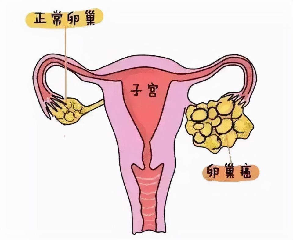 这些风险因素都可能引起卵巢癌!做好这7个预防,守护女性健康