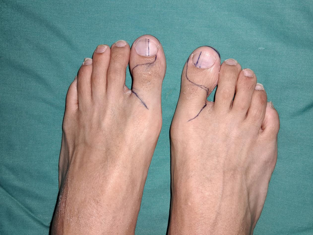 无名指残端进行清创处理,根据缺损手指大小在双足踇趾设计带骨质的