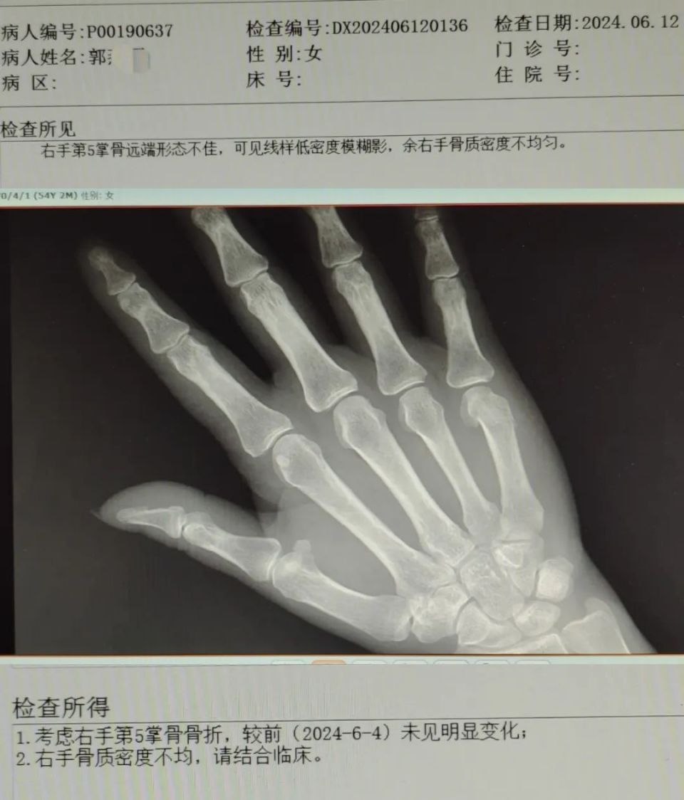 骨折一定要手术吗?