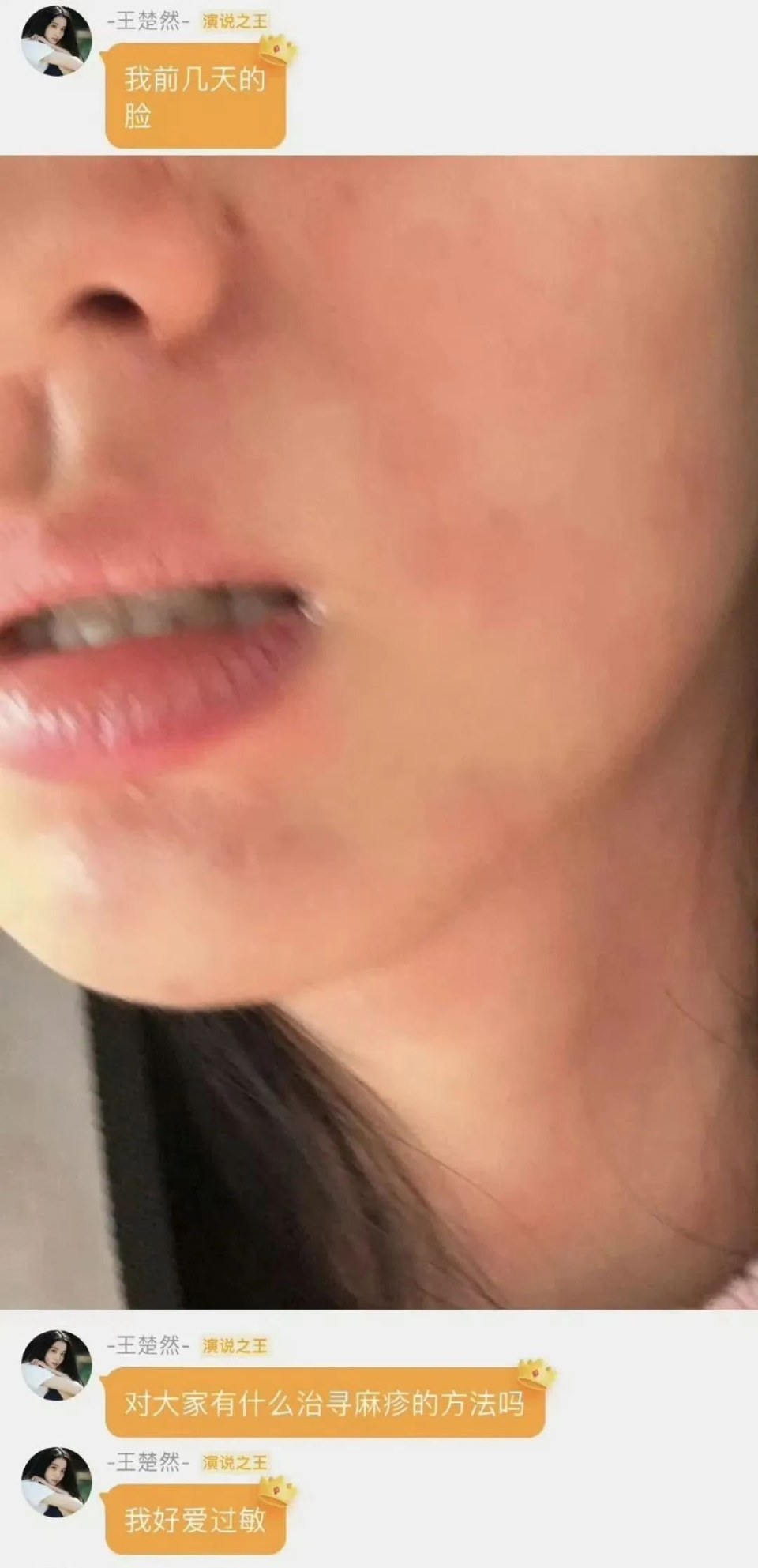 演员王楚然求助荨麻疹治疗方法引关注！你也被这‘皮肤上的闪电战