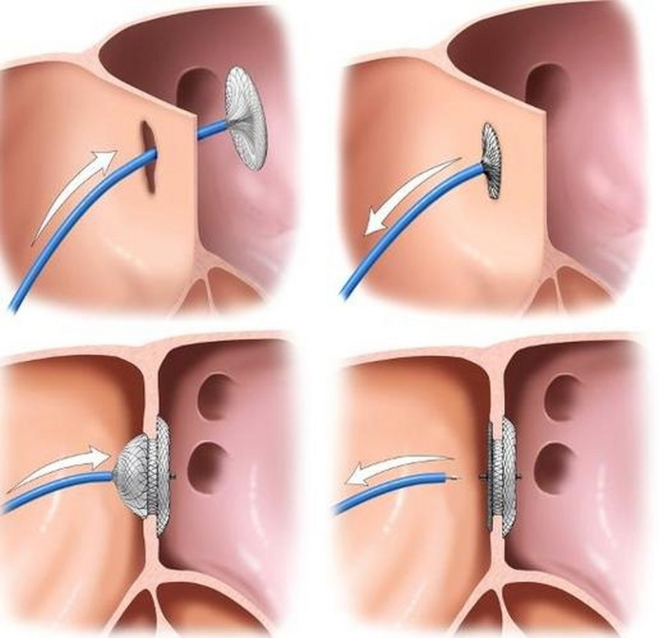 女子头痛10多年服药不好,发现心脏"卵圆孔未闭",要不要封堵?
