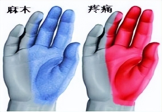 腕管综合征治疗方法_腾讯新闻