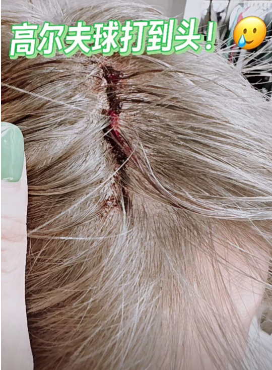 50岁孙耀威被高尔夫球打破头公开受伤照惹人心疼自侃要中头彩