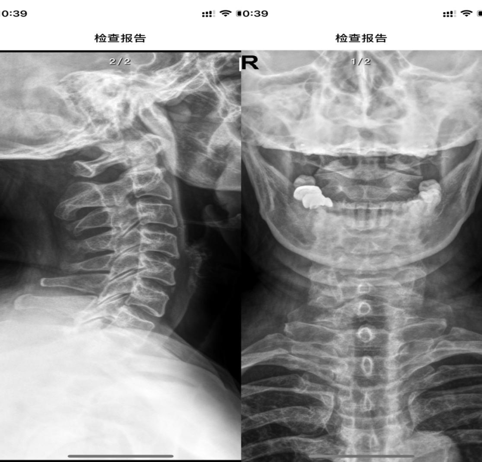 2024-8-2颈椎dr专科描述:颈椎生理曲度存在,椎体边缘骨质增生,寰齿