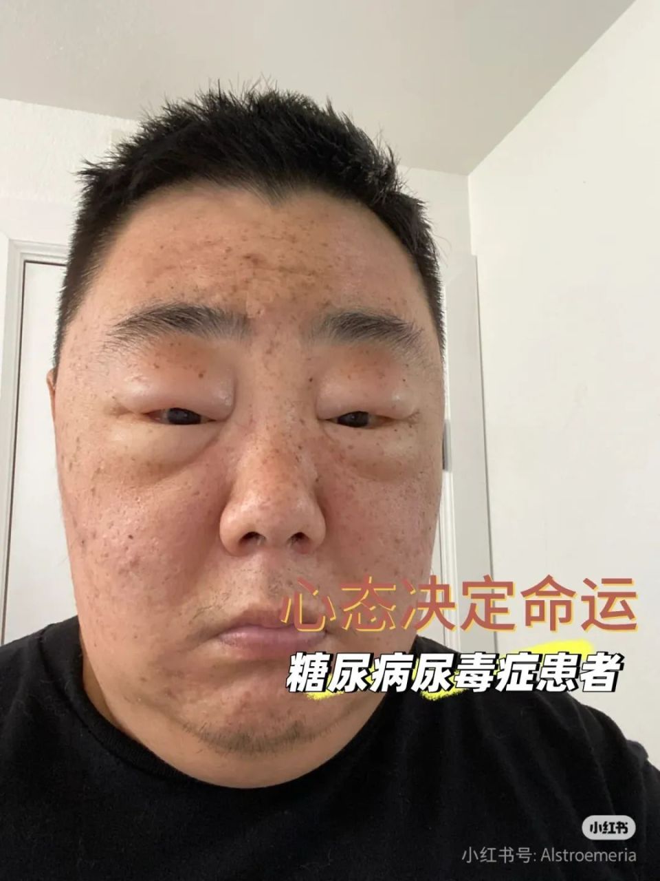 身患尿毒症仍四处游玩！是心态强大还是另有原因？