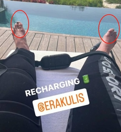 39岁c罗晒度假照球迷心疼总裁双脚肿胀变形脚趾甲脱落