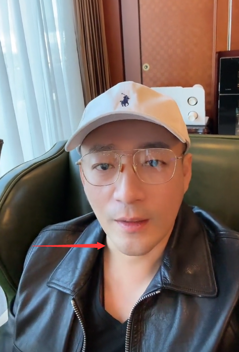 汪小菲新冠痊愈复工,嗓子沙哑脖子上肿包明显,身体状况令人担忧_腾讯