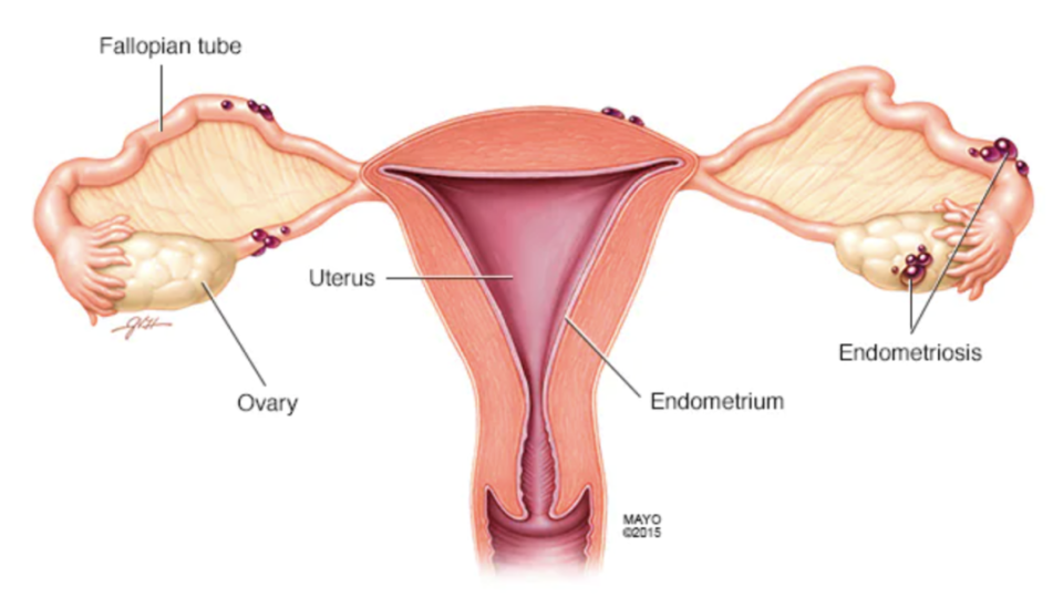一种高发却常被忽视的妇科病,可能正在悄悄伤害你的卵巢