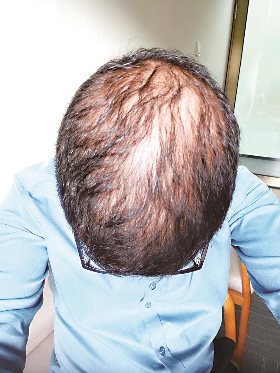 花费近3万福州一男子称植发后更稀疏门店却已人去楼空