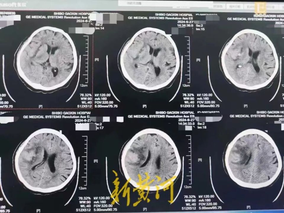 世博高新医院病例分享一名服用过阿司匹林的脑出血患者救治历程