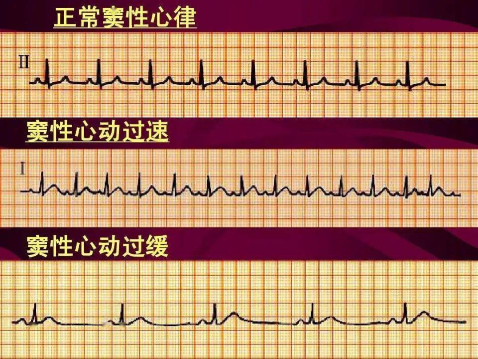 窦性心动过速: 病因、症状及治疗与预防措施
