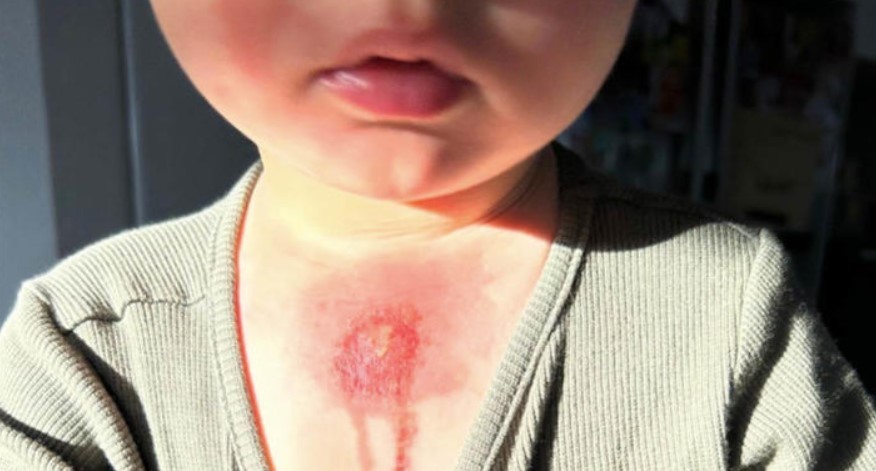 去年11月,一名儿童在接触酸橙后胸部也遭受了类似的灼伤.