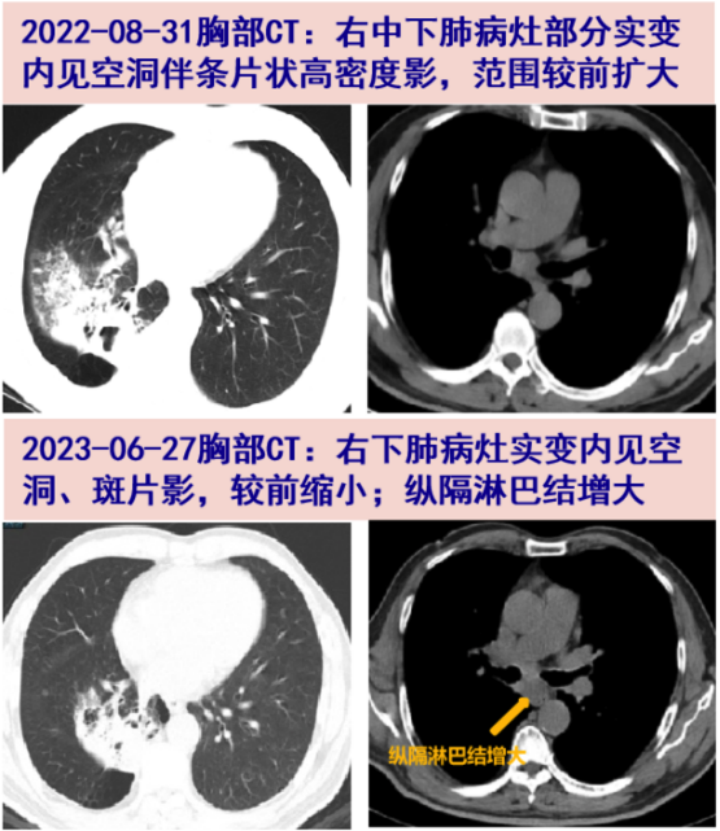 一什么诊断床当着主任的面吵起来了！痰培养阳性，治疗 2 年仍诊断不明...-上海聚慕医疗器械有限公司