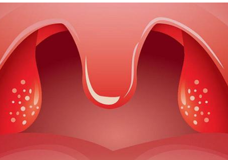 扁桃体发炎最快治疗方法（快速治疗扁桃体发炎）