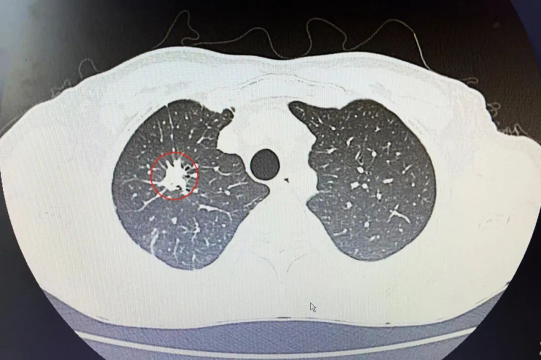 61岁的宋先生,查出右肺下叶背段结节,左肺上