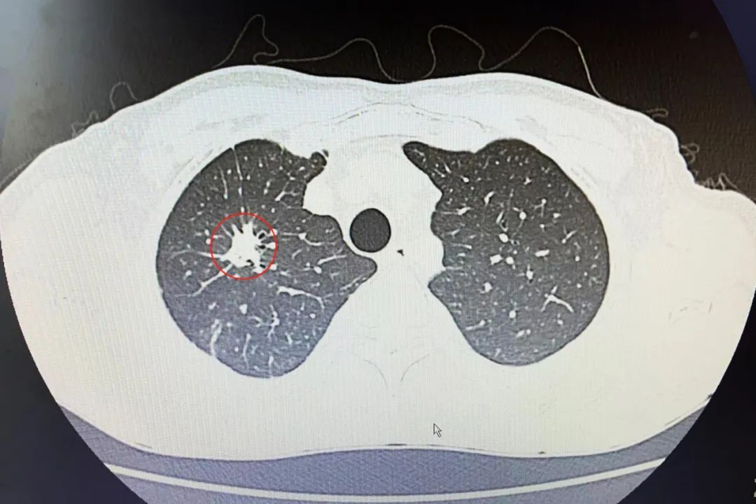 正常肺部ct图恶性肿瘤图片
