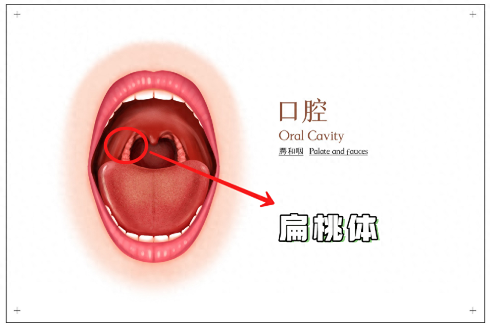 扁桃體是位於口咽部背側兩側的淋巴組織結構,起著抵抗感染和保護呼吸