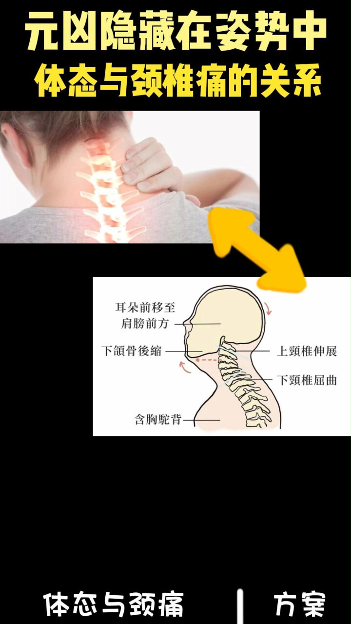 元凶隐藏在姿势中：体态与颈椎痛的关系_腾讯新闻