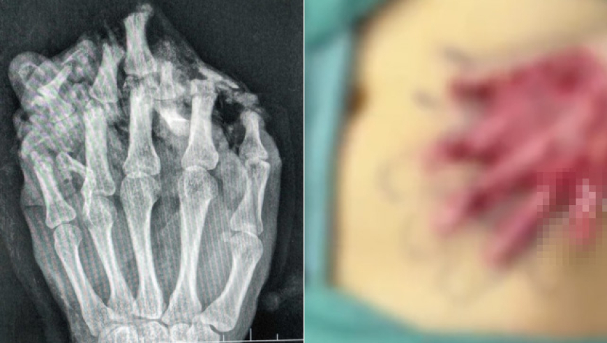 24岁男子手指不慎被机器碾压，医生将“伤手”寄养在其肚子1个月，成功把粘连手指分开后再进行手术