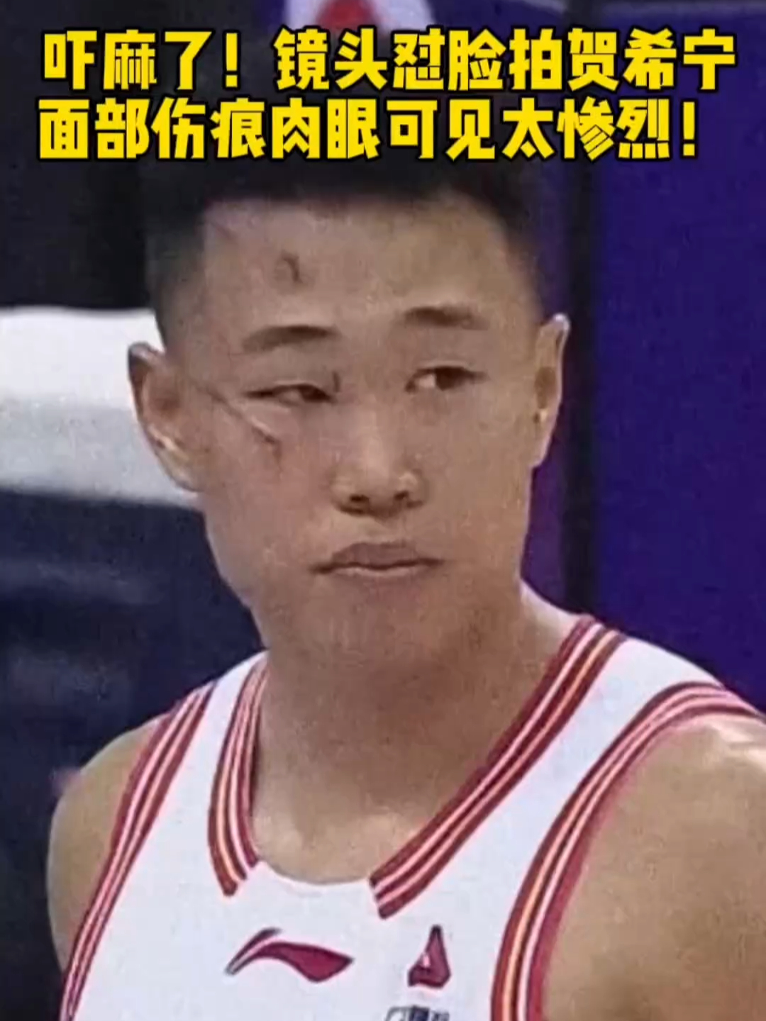 吓麻了！镜头怼脸拍贺希宁，面部伤痕肉眼可见太惨烈_腾讯新闻