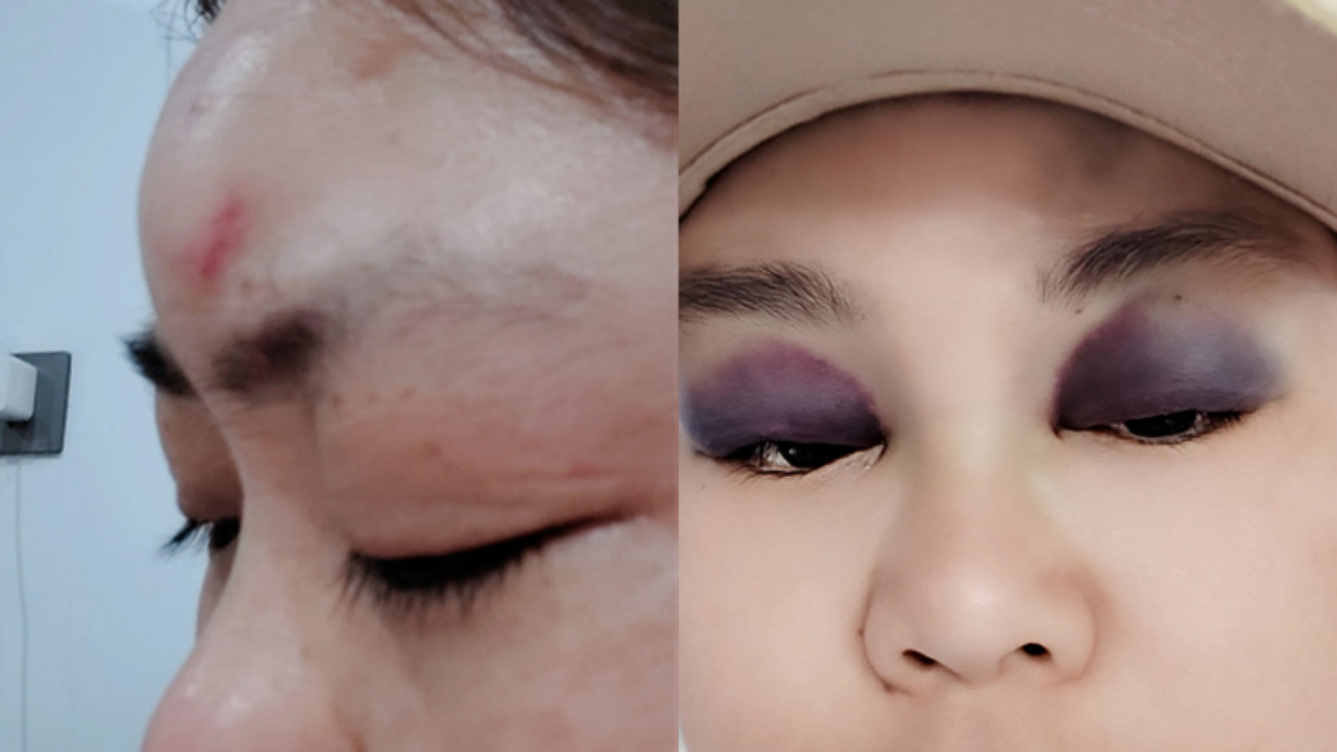 女子磕伤额头，隔天眼部竟出现严重淤青肿胀，变成“熊猫眼”_腾讯新闻