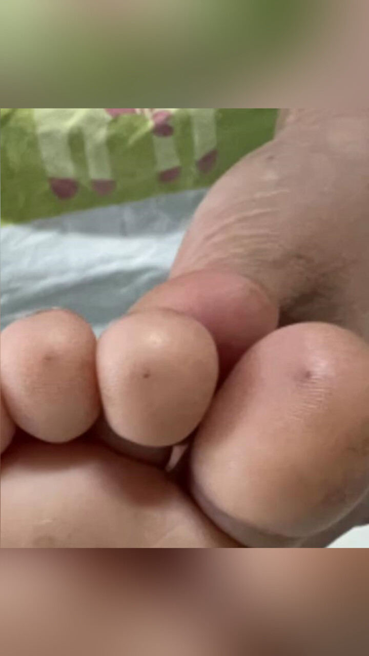 广东1岁女童土方退烧双手双脚扎满针眼 医生:不仅没帮助,还可能有危险