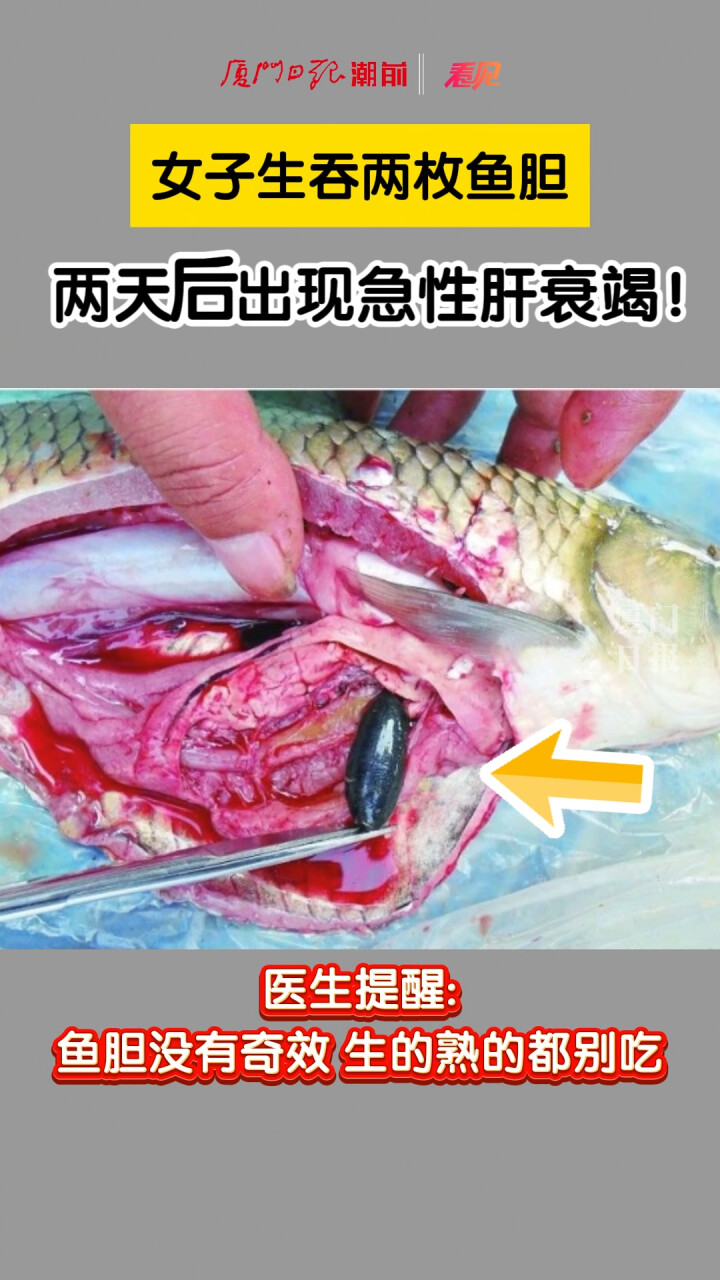 可怕！女子生吞两枚鱼胆，两天后出现急性肝衰竭！_腾讯新闻