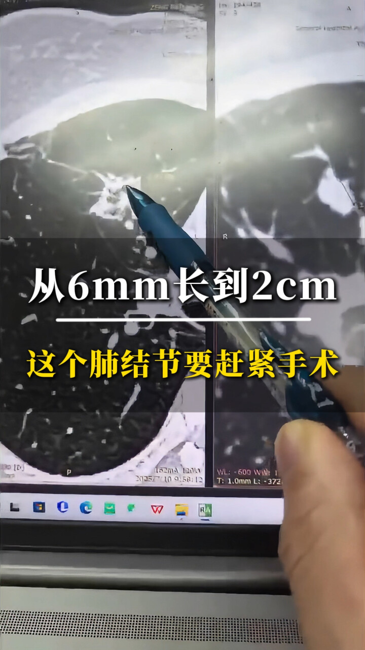 为什么转移到肺就完了