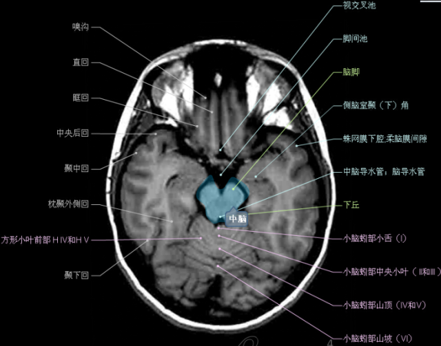 顱腦斷層解剖頭顱mr軸位解剖圖彩色標註版