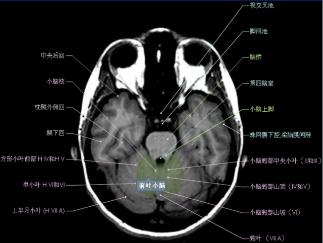 顱腦斷層解剖頭顱mr軸位解剖圖彩色標註版