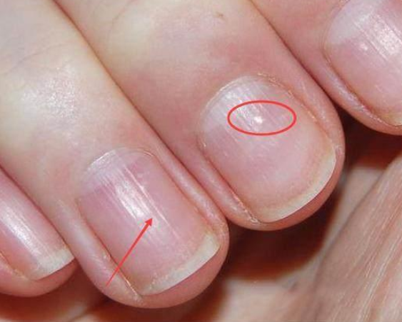 肠道疾病如果指甲表面出现由指尖向指甲根部延伸,那就显示患有肠道