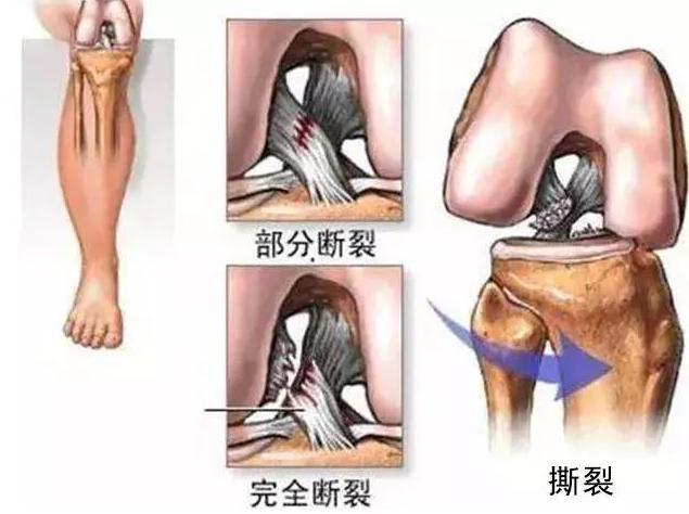 辟谣前交叉韧带撕裂 一定要手术吗 如果不做 会有啥后果