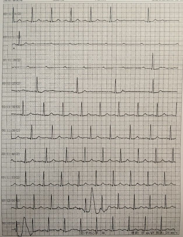 106875 次,心室率 13-104 次/分,平均 76 次/分);② 室性停搏(最长