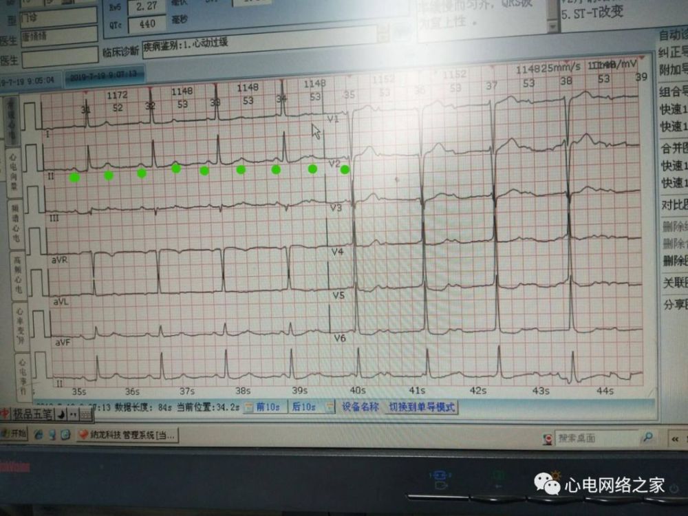 心電圖實例解圖系列127三度房室傳導阻滯心電系列