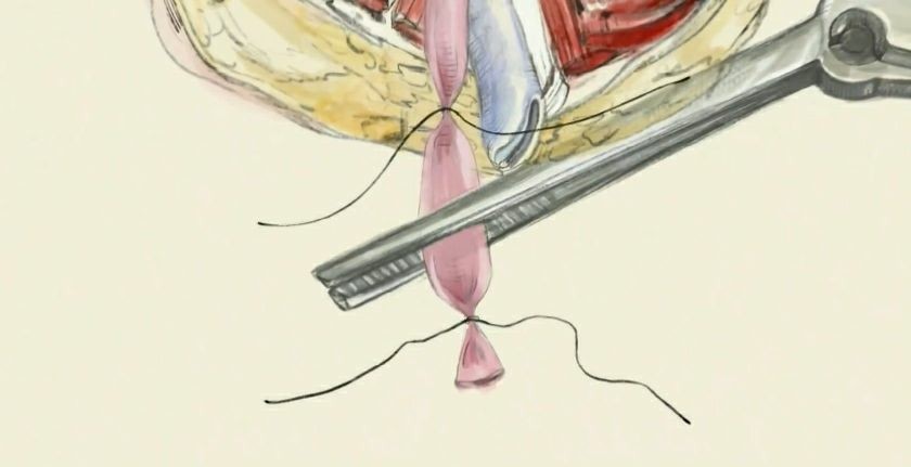 医疗止血第一人安布鲁瓦兹帕雷钳夹止血法的出现