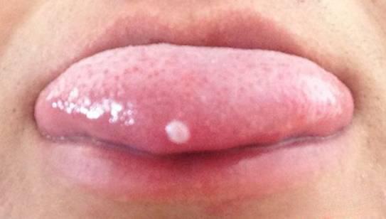 口腔溃疡竟成癌 这是怎么回事