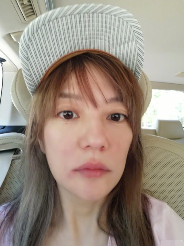赵薇晒素颜照,忙公益片后期满脸上火起大包,惹人心疼!
