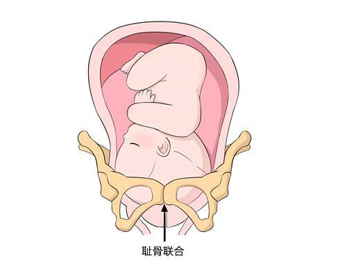 疼得不能走路 不能翻身 孕期疼痛需要这四招来缓解