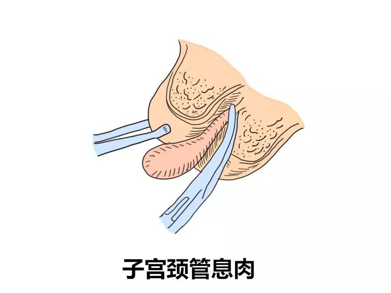应对方法:宫颈管息肉大部分是良性的.正常情况下无需在孕期进行治疗.